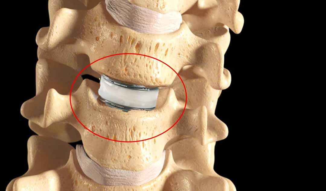 Phương pháp điều trị mới cho bệnh thoát vị đĩa đệm (bệnh thoái hóa đĩa đệm) là gì?