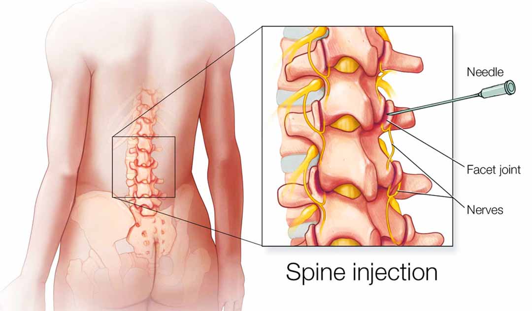 Liệu có thuốc nào chữa được hẹp ống sống không?