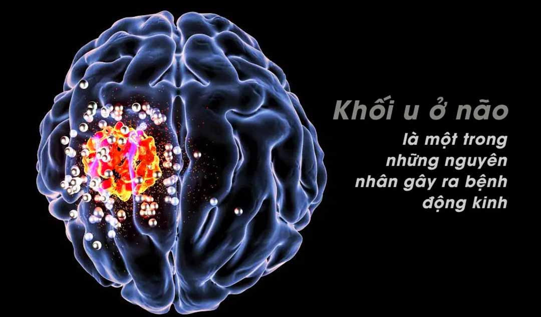 Nguyên nhân gây ra bệnh động kinh?