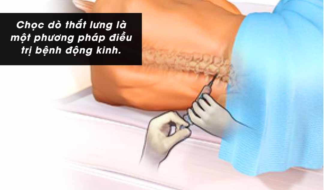 Phương pháp chọc dò thắt lưng là gì?