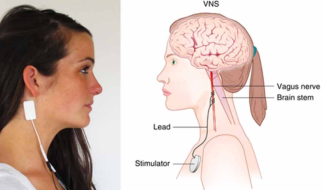 Việc kích thích thần kinh phế vị có trị được bệnh động kinh?