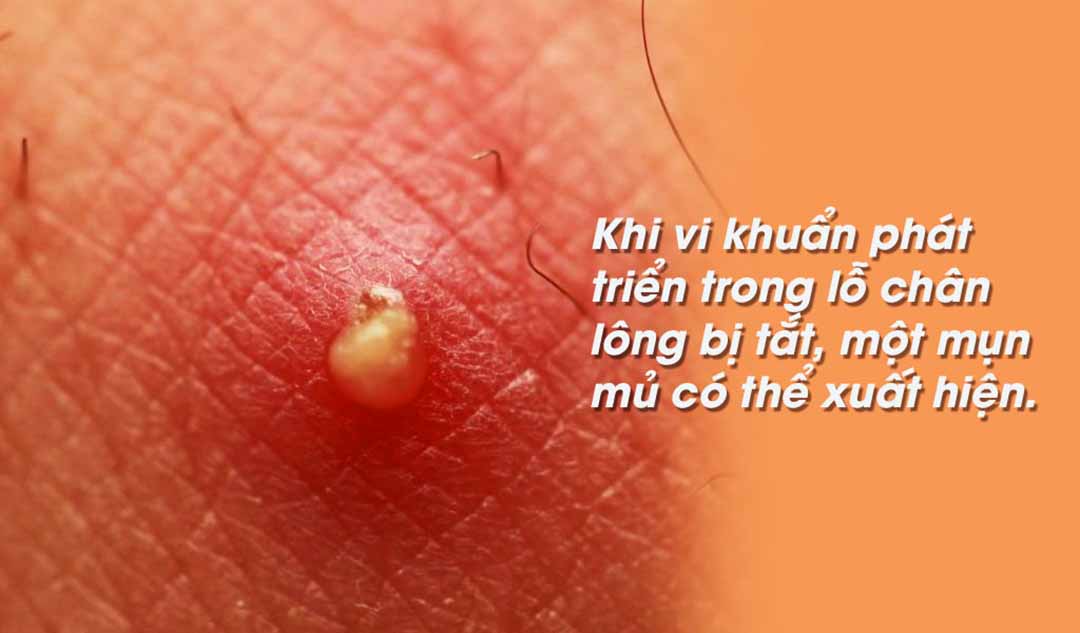 Điều gì xảy ra khi vi khuẩn phát triển trong lỗ chân lông bị tắt?