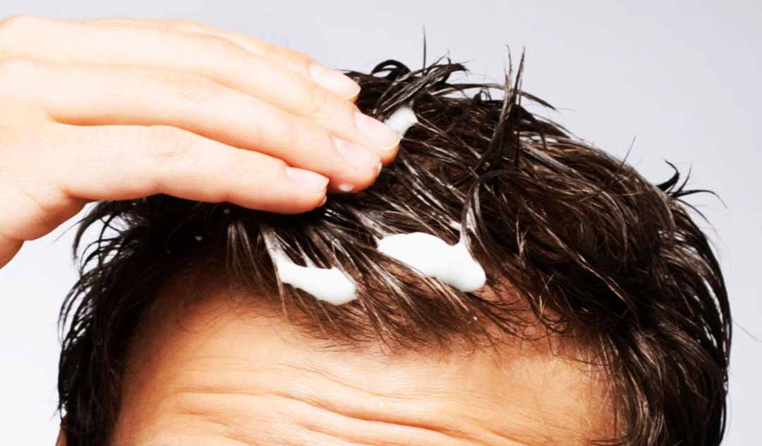 Những sản phẩm về tóc có gây mụn không?