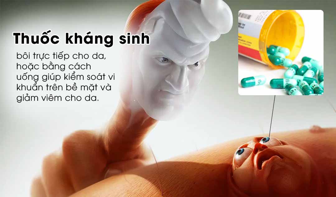 Thuốc kháng sinh có thể giúp trị mụn trứng cá không?