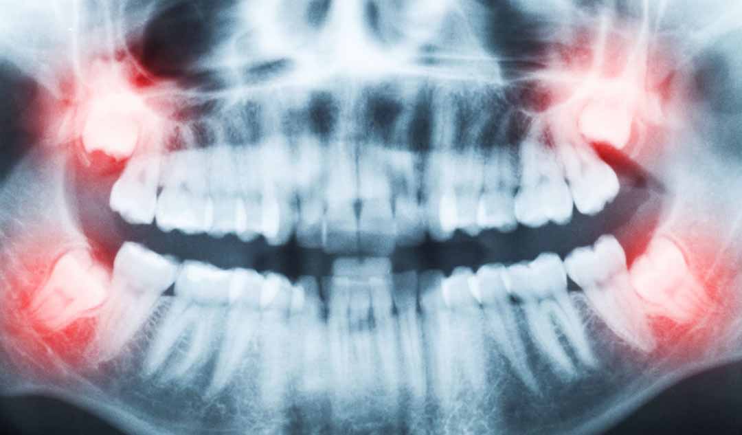 Tôi nên làm gì sau khi nhổ răng khôn?