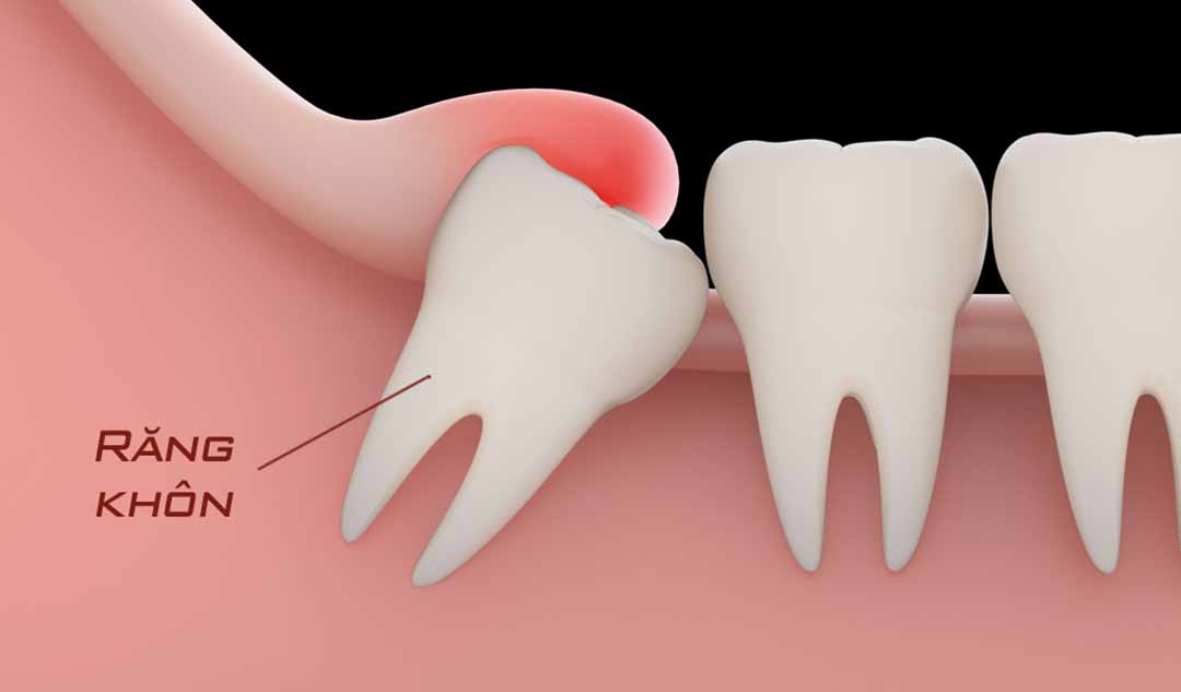 Bạn nên tránh làm gì sau khi nhổ răng khôn?