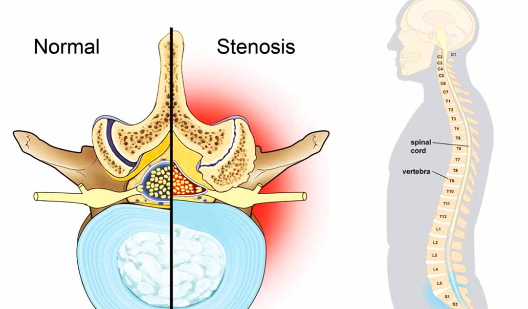 Chứng hẹp ống sống thắt lưng là gì?