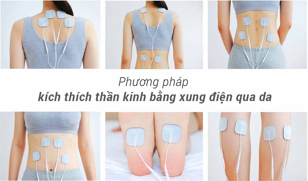 Phương pháp kích thích thần kinh bằng xung điện qua da (TENS - Transcutaneous electrical nerve stimulation) là gì?