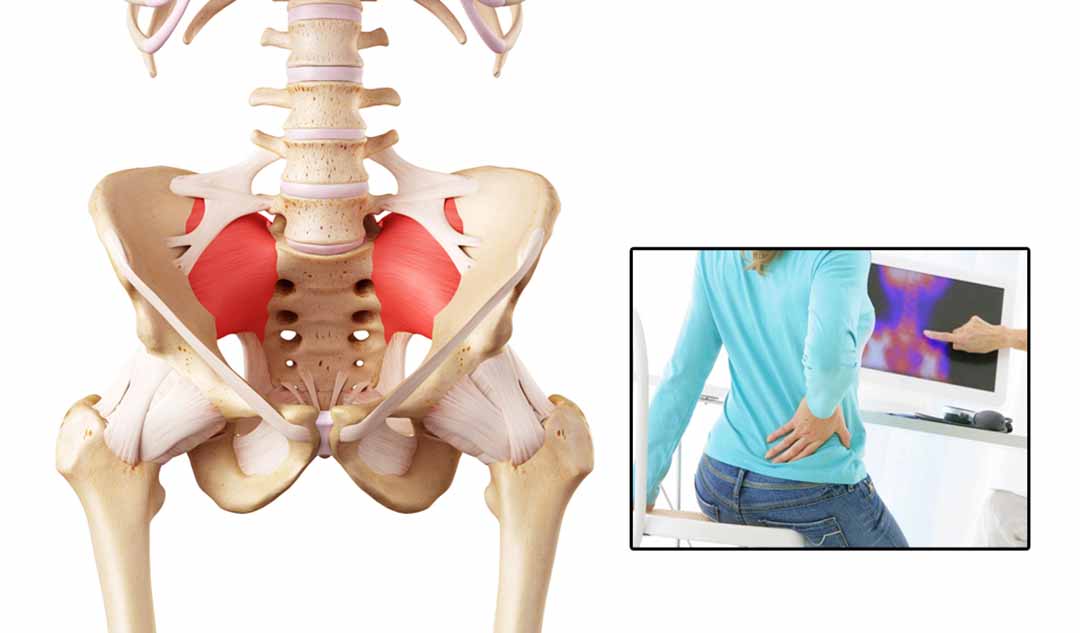 Khớp cùng chậu là gì và các vấn đề về nó có thể dẫn đến bệnh đau lưng thế nào?