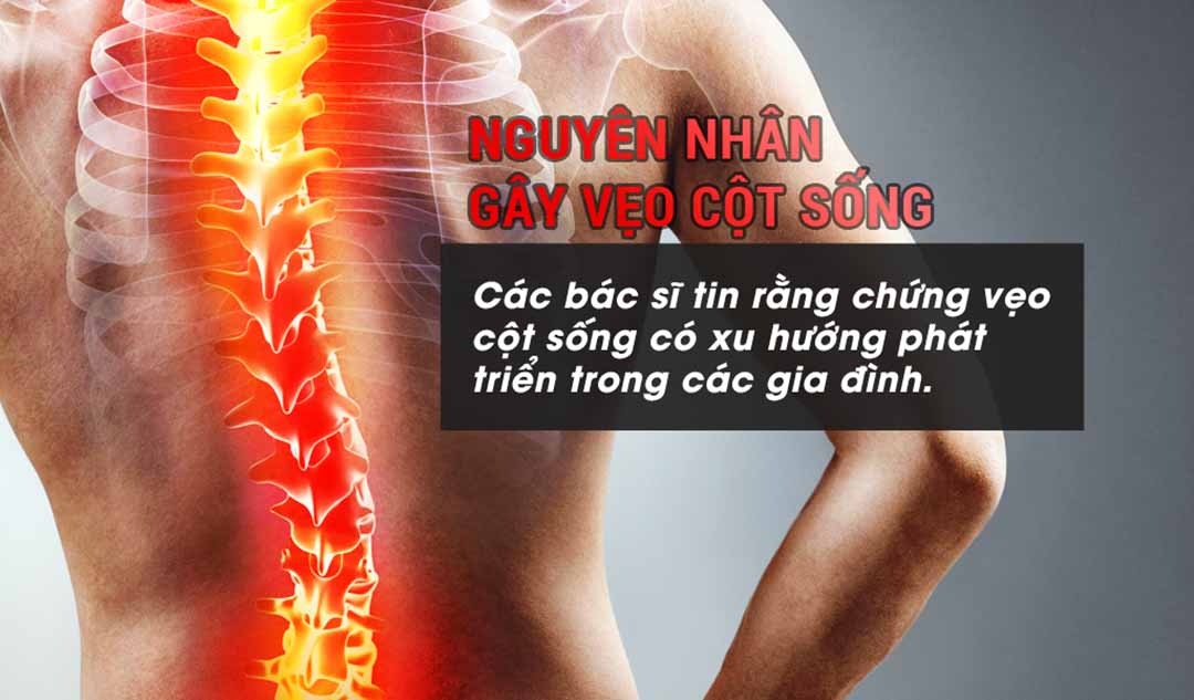 Nguyên nhân gây vẹo cột sống?