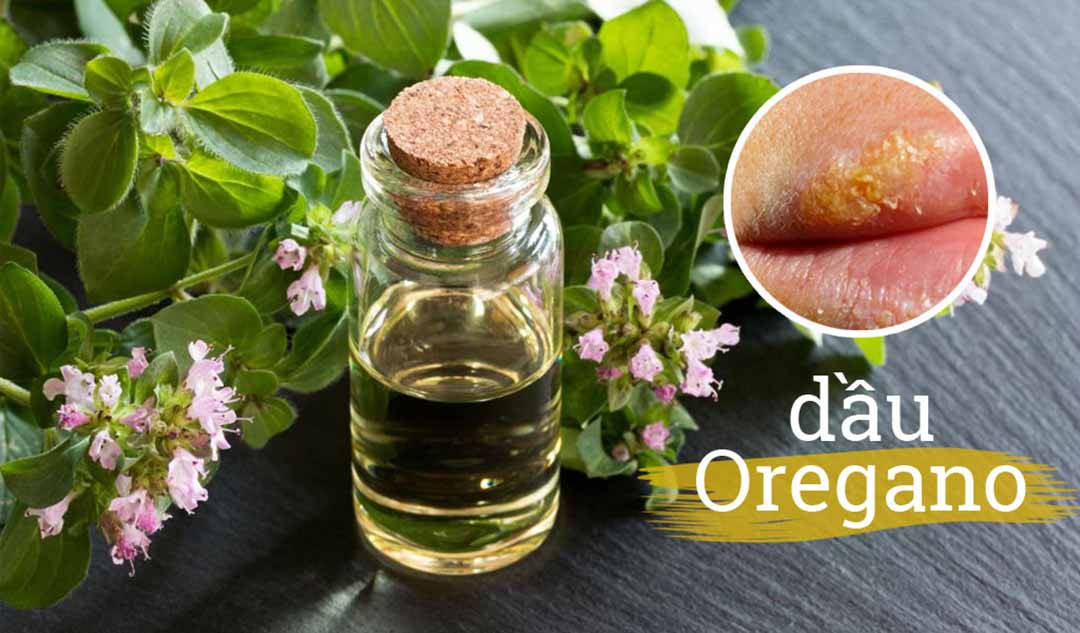 Những tình trạng da nào có thể được điều trị bằng dầu Oregano?