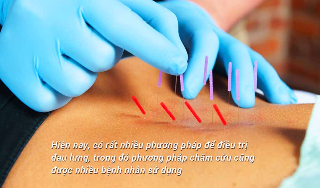 Phương pháp châm cứu được sử dụng để điều trị đau lưng như thế nào?