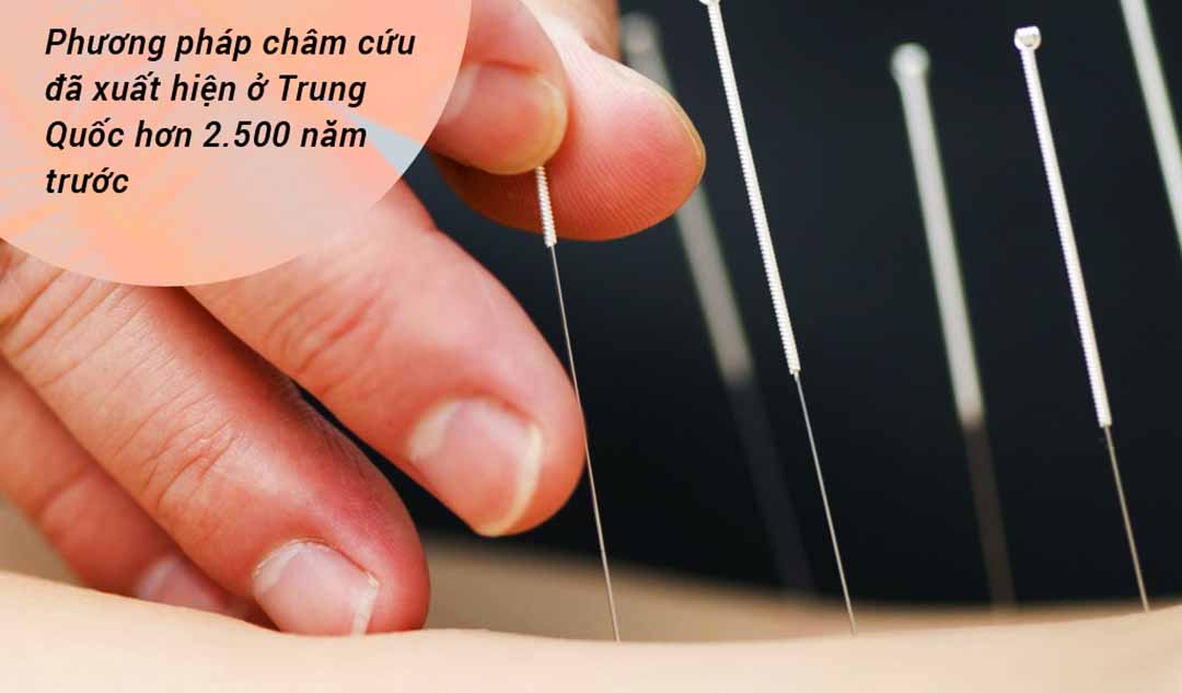 Phương pháp châm cứu làm giảm đau lưng như thế nào?