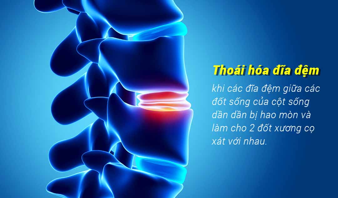 Thoái hóa đĩa đệm là bệnh gì?