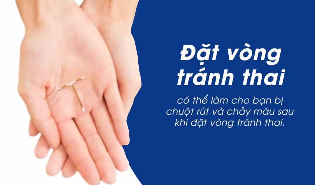 Có phải đặt vòng tránh thai không?