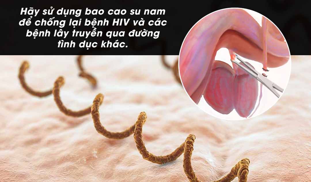 Thắt ống dẫn tinh có bảo vệ chống lại STDs?