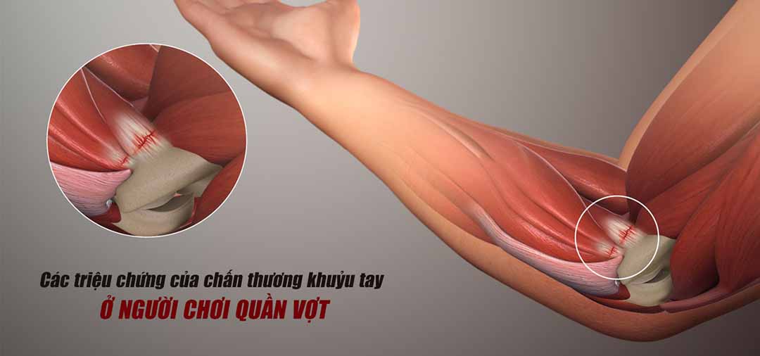 Các triệu chứng của chấn thương khuỷu tay ở người chơi quần vợt là gì?