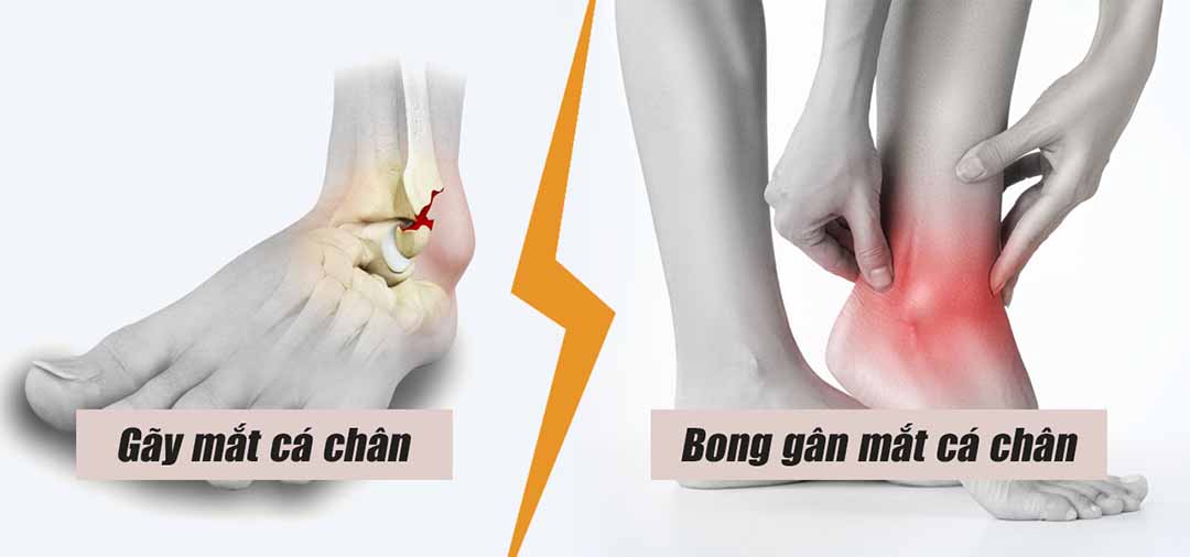 Gãy mắt cá chân so với bong gân mắt cá chân là gì?