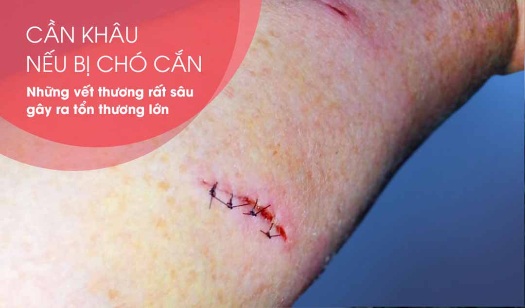 Tôi sẽ cần khâu nếu bị chó cắn?