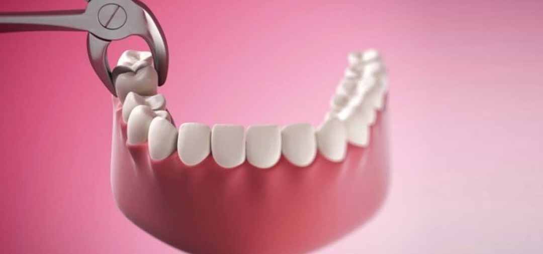 Bạn nên làm gì trước khi nhổ răng khôn?