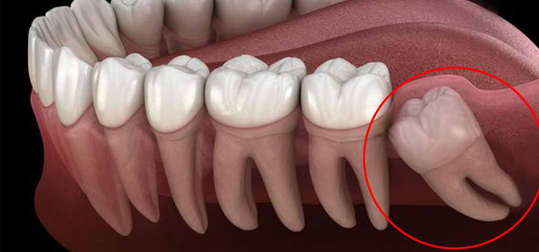 Khi nào phải nhổ răng khôn?  