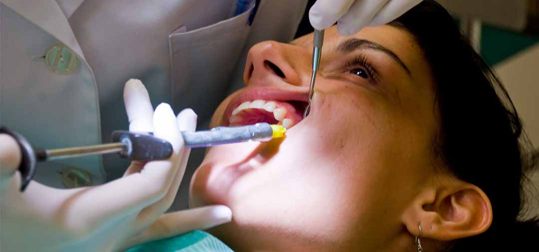 Điều gì xảy ra trong quá trình nhổ răng khôn?