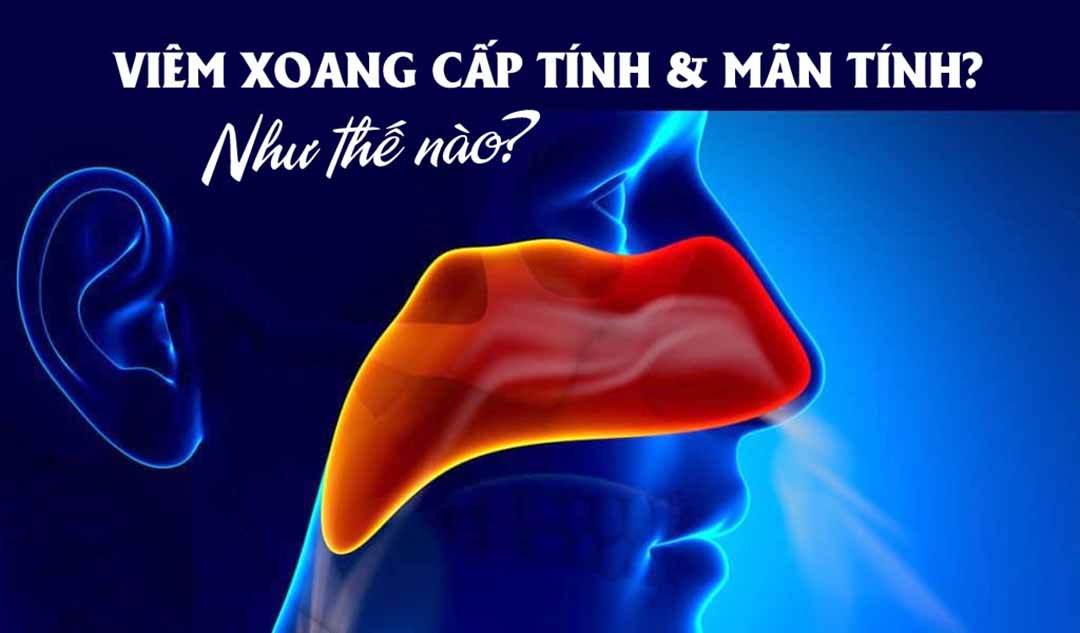 Như thế nào là viêm xoang cấp tính và mãn tính?