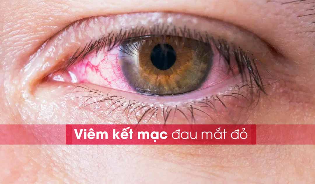 Viêm kết mạc (đau mắt đỏ) là gì và tình trạng này có phổ biến hay không?