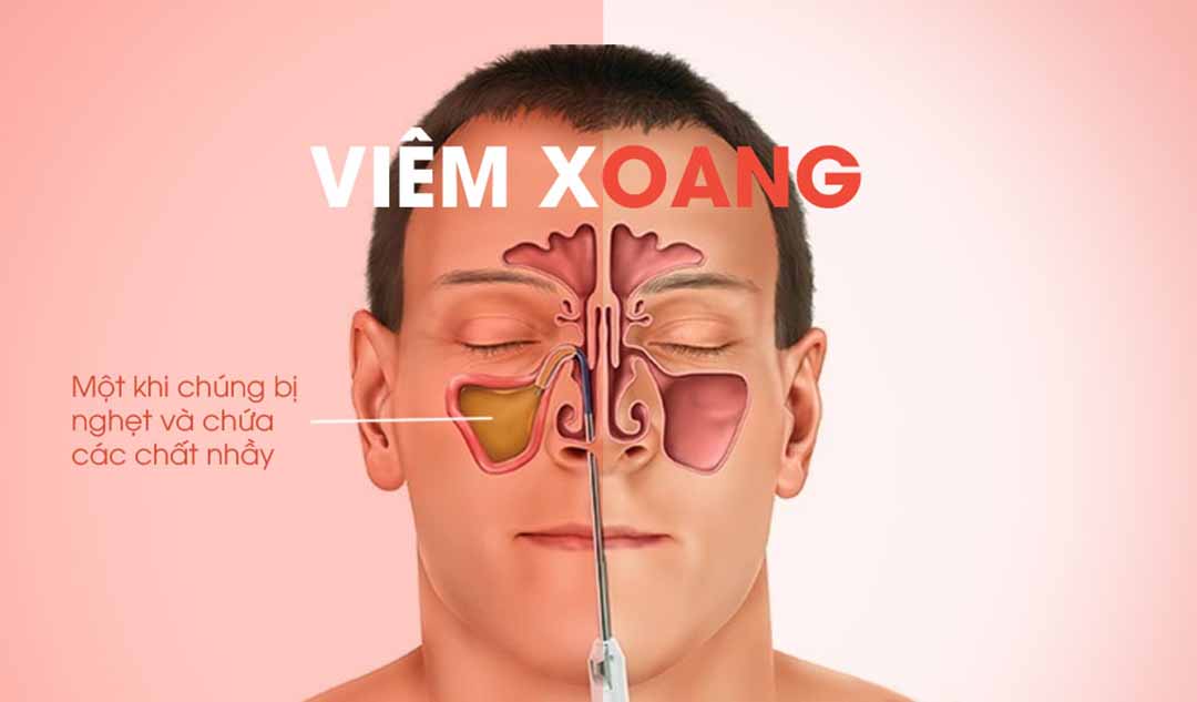 Viêm xoang là gì và tình trạng này gây ảnh hưởng ra sao?