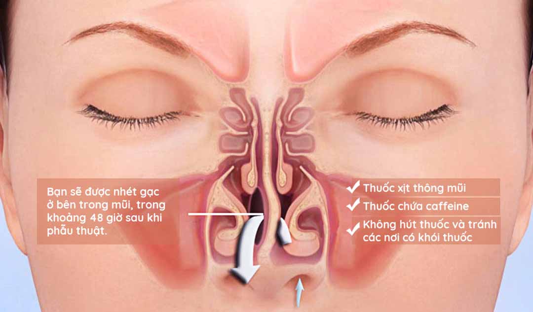 Bạn sẽ có những dấu hiệu gì sau khi phẫu thuật vách ngăn mũi?