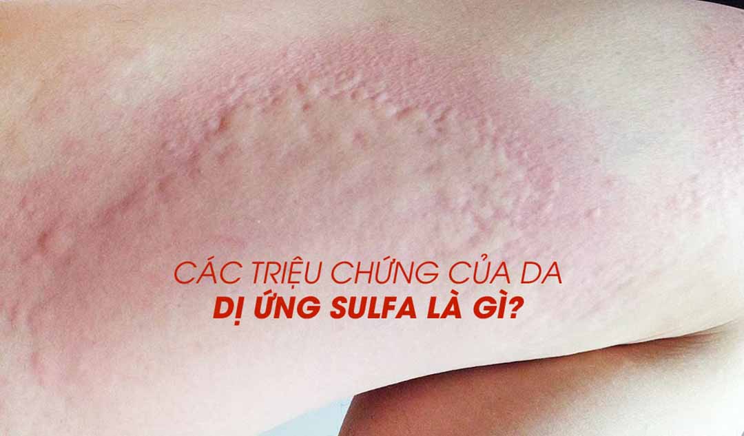 Các triệu chứng của da dị ứng sulfa là gì?