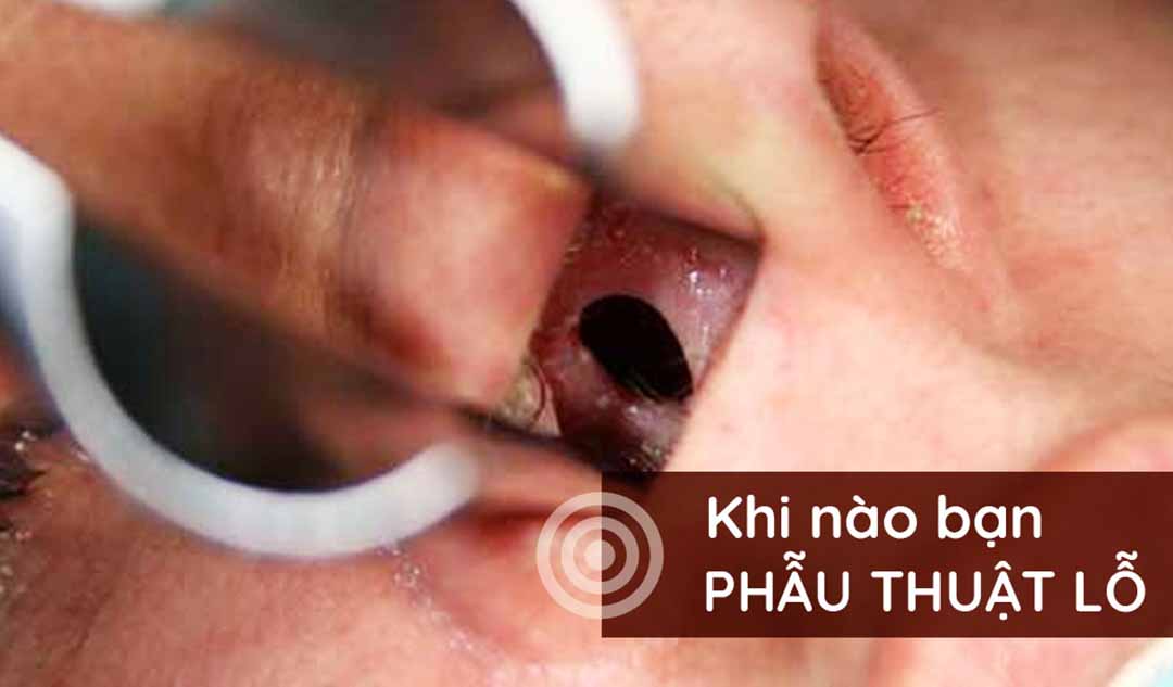 Khi nào bạn nên phẫu thuật lỗ trên vách ngăn mũi?