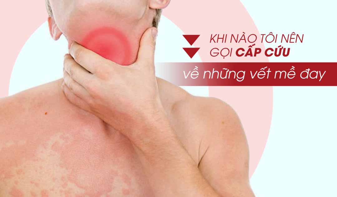 Khi nào tôi nên gọi cấp cứu về những vết mề đay?