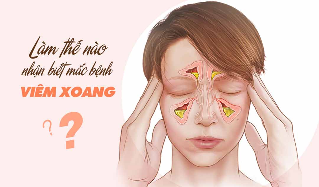 Làm thế nào để nhận biết khi mắc bệnh viêm xoang?