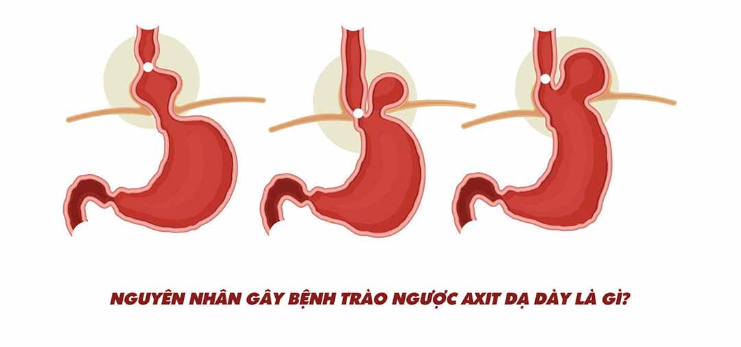  Nguyên nhân gây bệnh trào ngược axit dạ dày là gì?