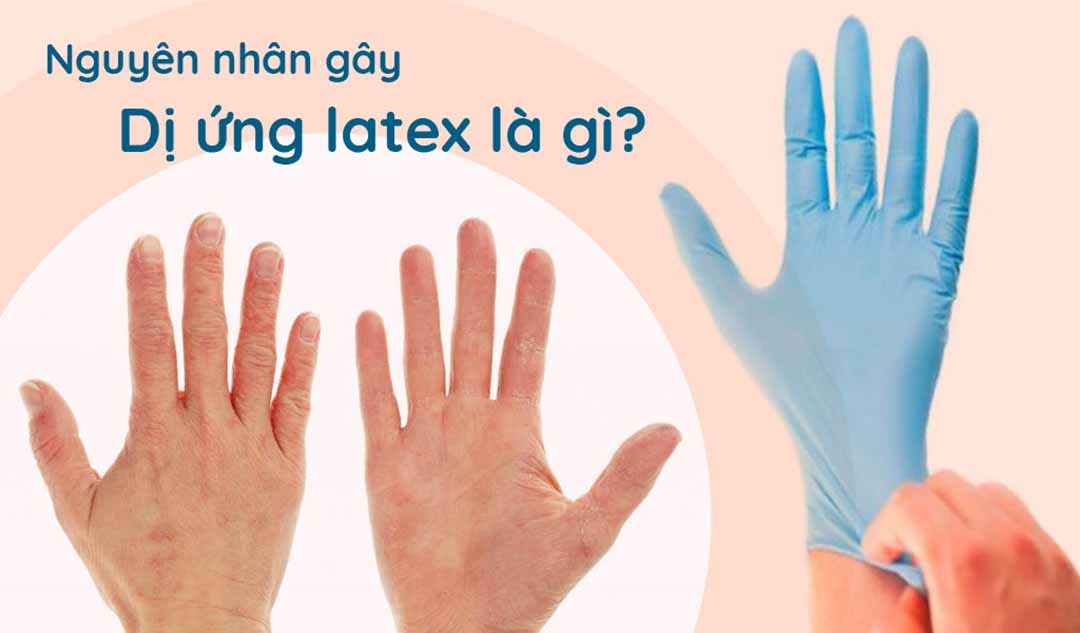 Nguyên nhân gây dị ứng latex là gì?