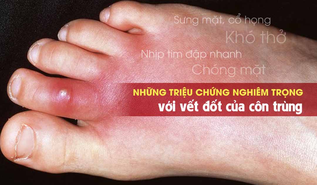 Những triệu chứng nghiêm trọng với vết đốt của côn trùng là gì?