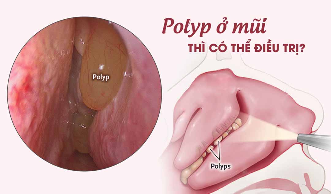 Bị polyp ở mũi thì có thể điều trị như thế nào?