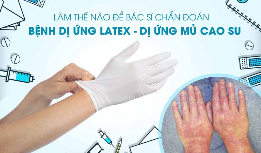 Làm thế nào để bác sĩ chẩn đoán bệnh dị ứng Latex - dị ứng mủ cao su?