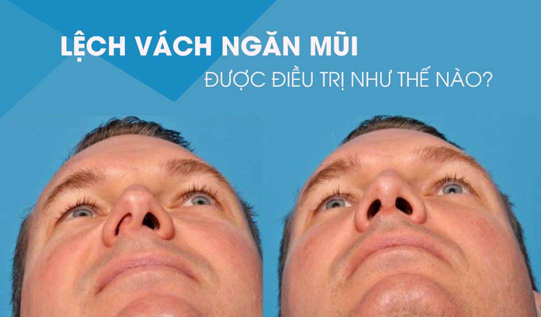 Lệch vách ngăn mũi được điều trị như thế nào?