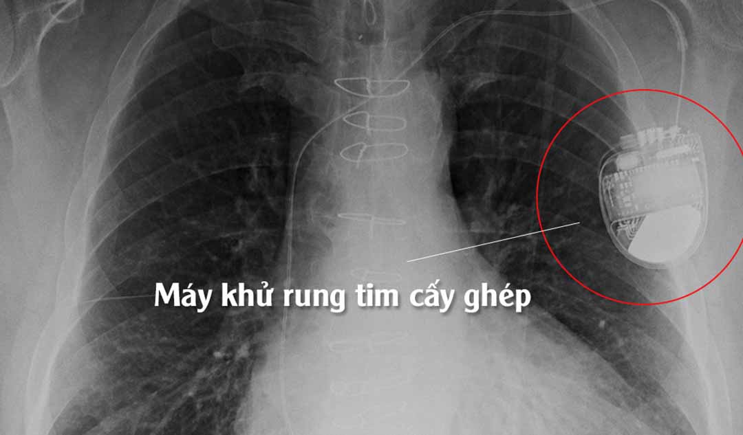 Những đối tượng nào có thể sử dụng Máy khử rung tim cấy ghép?