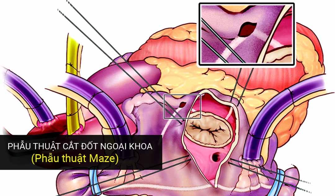 Phẫu thuật cắt đốt ngoại khoa có những loại nào ?