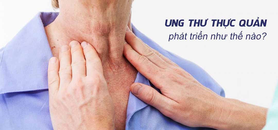  Ung thư thực quản phát triển như thế nào?