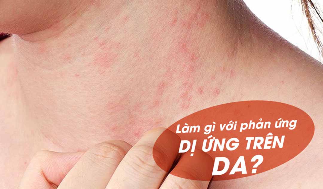 Bạn có thể làm gì với phản ứng dị ứng trên da?