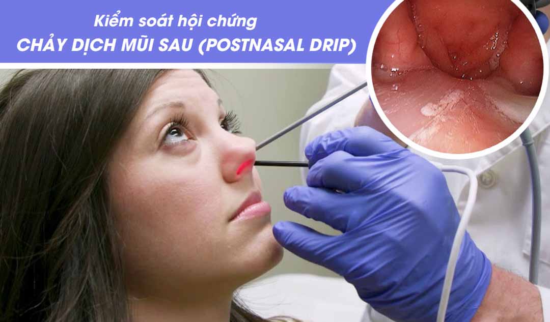 Làm thế nào bạn có thể kiểm soát hội chứng chảy dịch mũi sau (postnasal drip) do các triệu chứng dị ứng mũi?