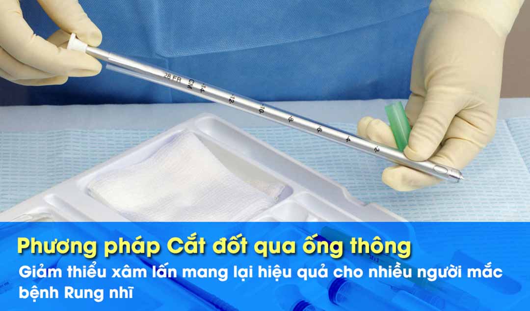 Phương pháp Cắt đốt qua ống thông để chữa bệnh Rung nhĩ mang lại hiệu quả như thế nào?