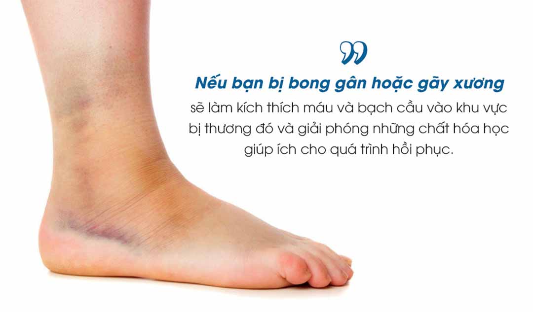 Bằng cách nào bạn có thể nhận biết được sưng chân là do bong gân hoặc gãy xương gây nên?