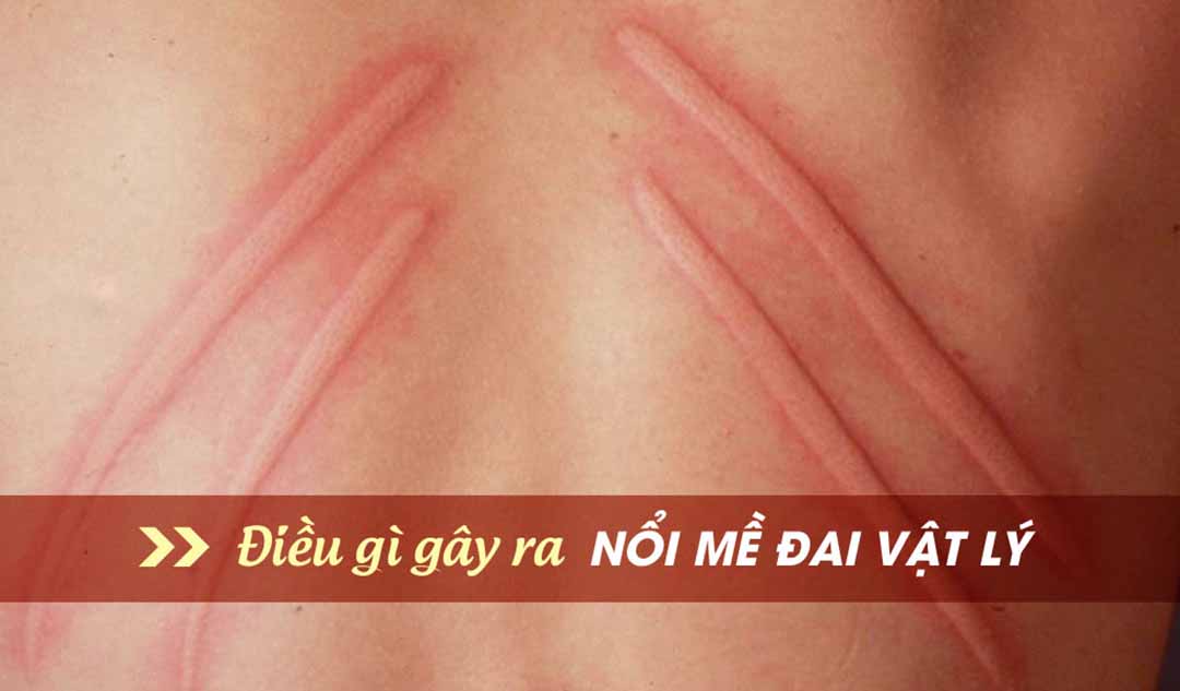 Điều gì gây ra nổi mề đay vật lý?