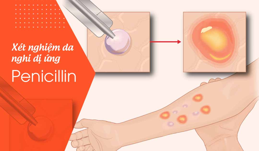 Điều gì xảy ra trong một xét nghiệm da nghi dị ứng penicillin?