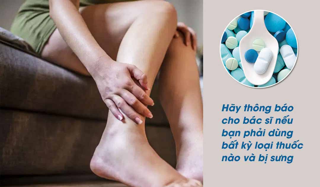 Làm thế nào để biết được hiện tượng sưng chân là do dược phẩm gây nên?